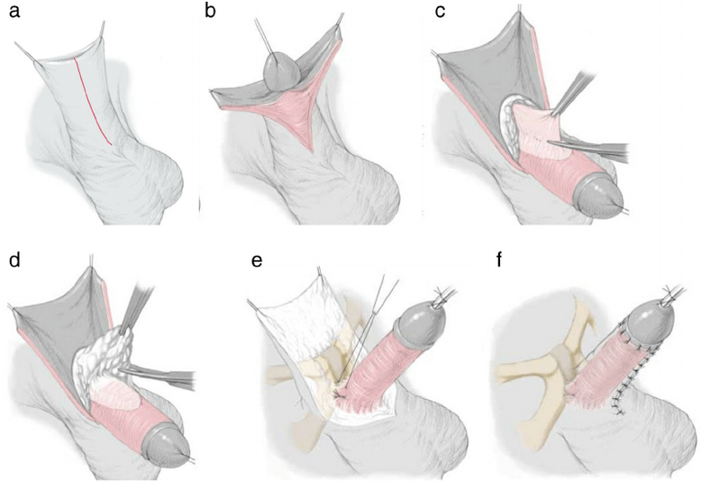 ligamentotomía para agrandar el pene